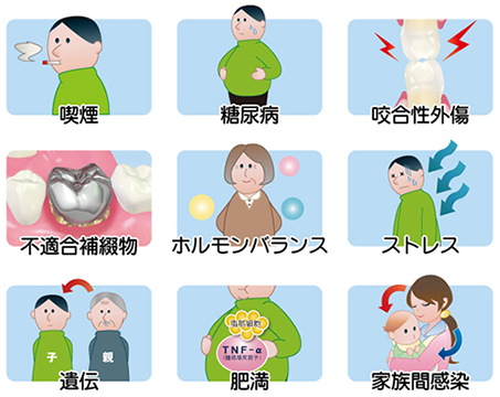 歯周病を進行させる因子（リスクファクター）