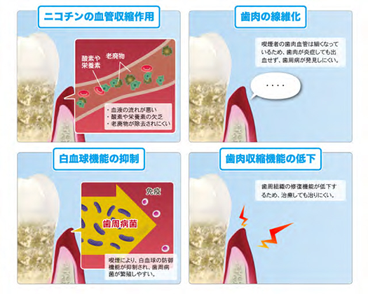 喫煙が口腔内に与える影響