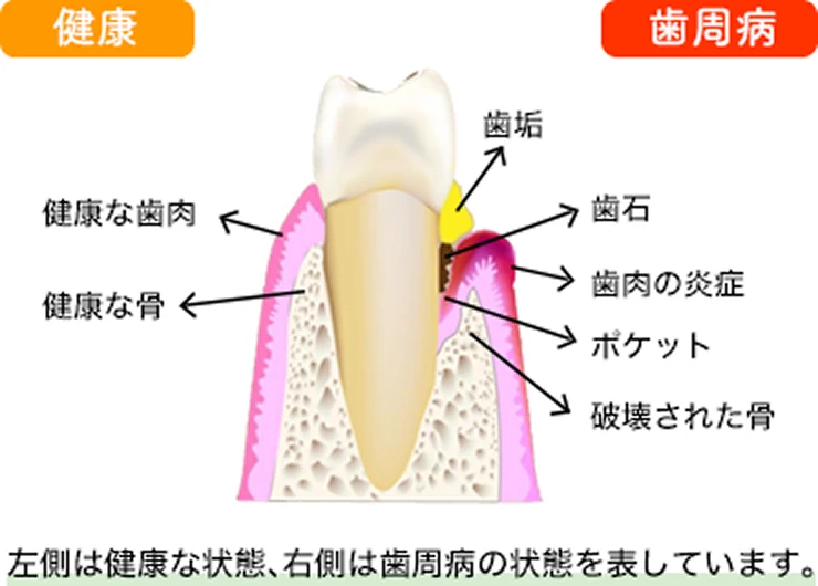 歯周病ってどんな病気？